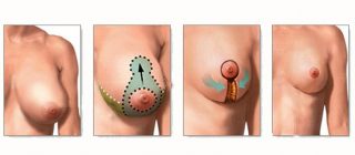 Редукционная маммопластика, уменьшение груди в Турции