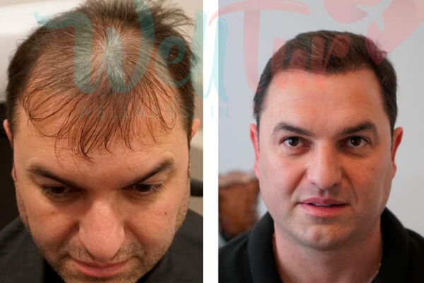 Фото пациентов WellTur: до и после пересадки 6